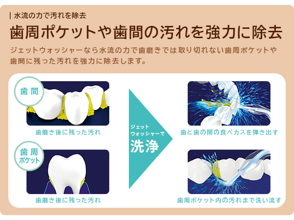 歯磨きでは取り切れない歯周ポケットや歯間に残った汚れを強力に除去