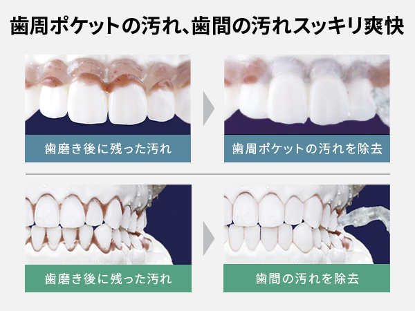 ジェットウォッシャーで口腔ケア