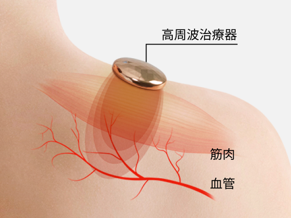 高周波は、血管に作用。無刺激
